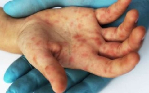 Brasil perderá certificado de país livre do sarampo